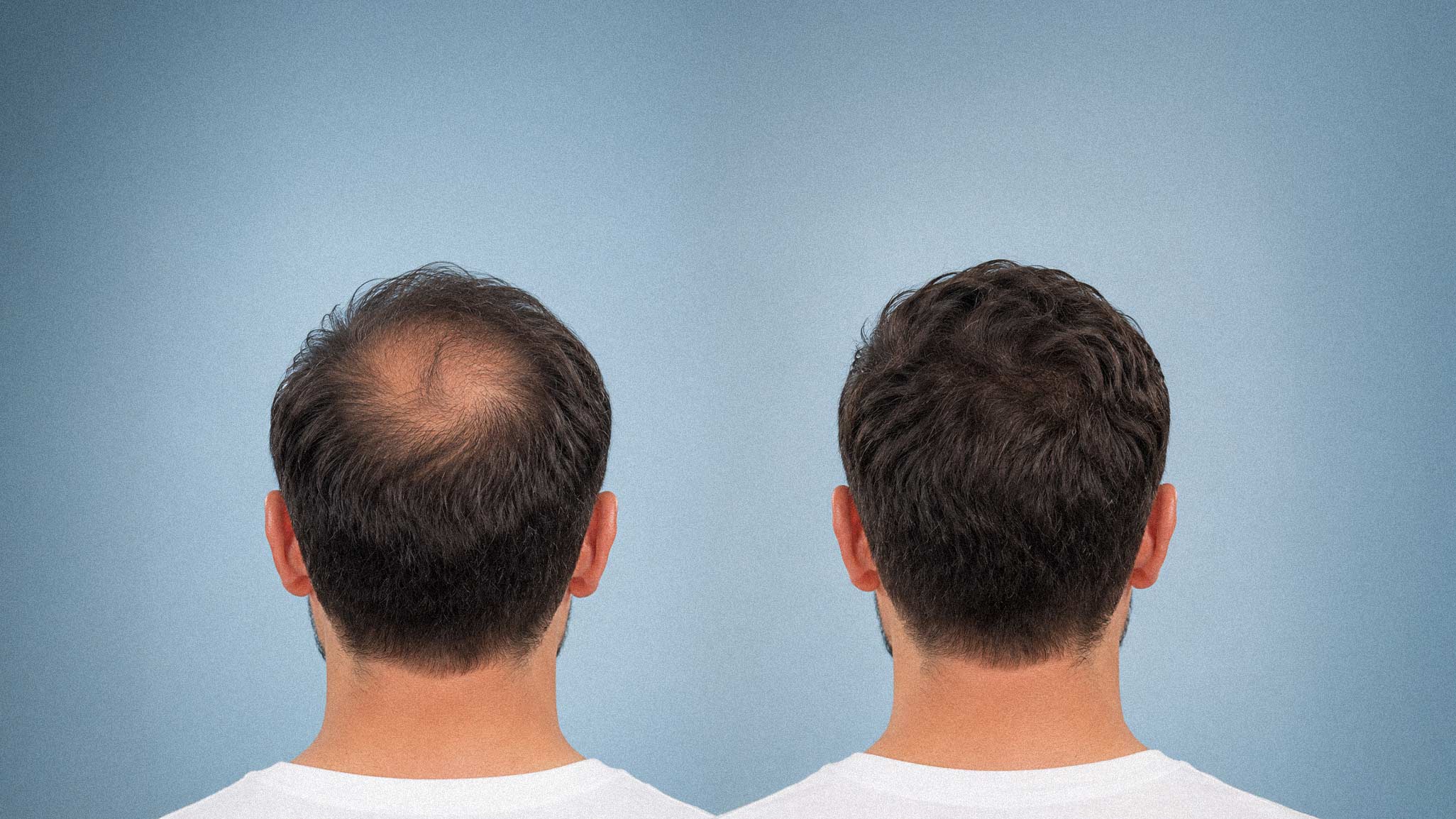 Could Hair Loss Be the Next GLP-1 Moment?