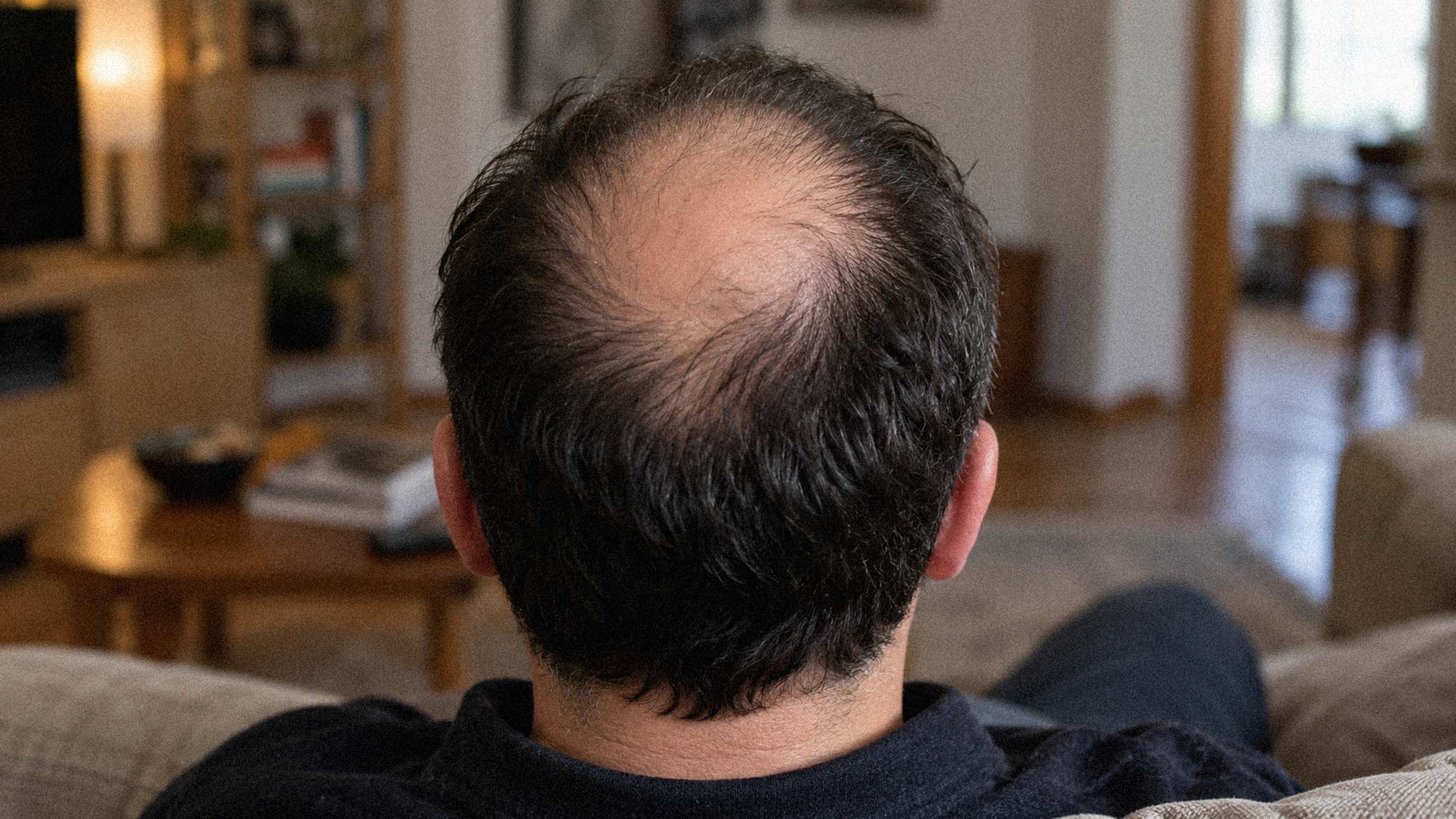 Veradermics' Oral Hair-Loss Pill Posts Strongest Phase 3 Numbers in the Field